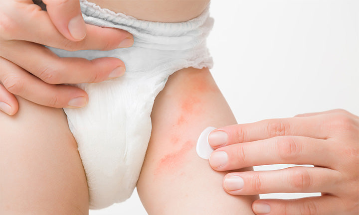 Applying diaper rash cream to baby’s leg