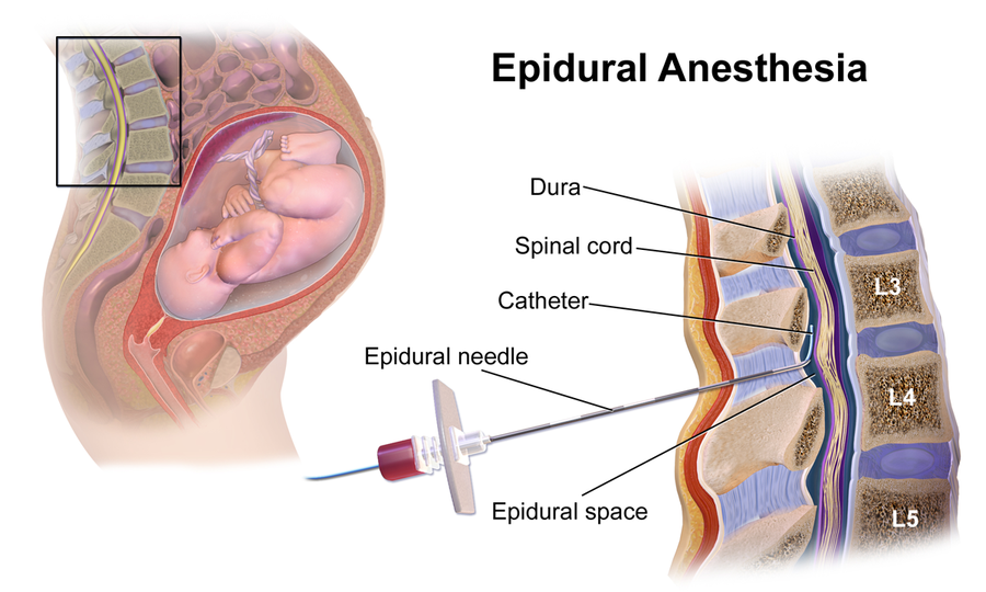 illustration of epidural use on pregnant woman
